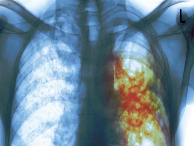 Kerala: Daily drug regime for Tuberculosis soon